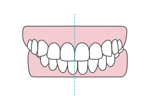 歯の中心がズレている・左右差（偏位）